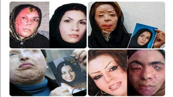 Iranian women victims of acid attacks by basij forces Iranian women victims of acid attacks by basij forces